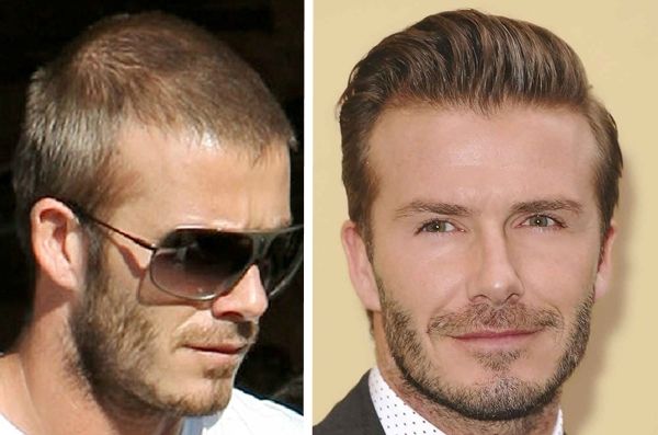 صور مشاهير قاموا بعمليات زراعة شعر Pwww6