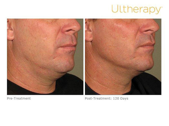تعرّفي إلى مواصفات جهاز Ultherapy لشباب دائم وجمال نضر 